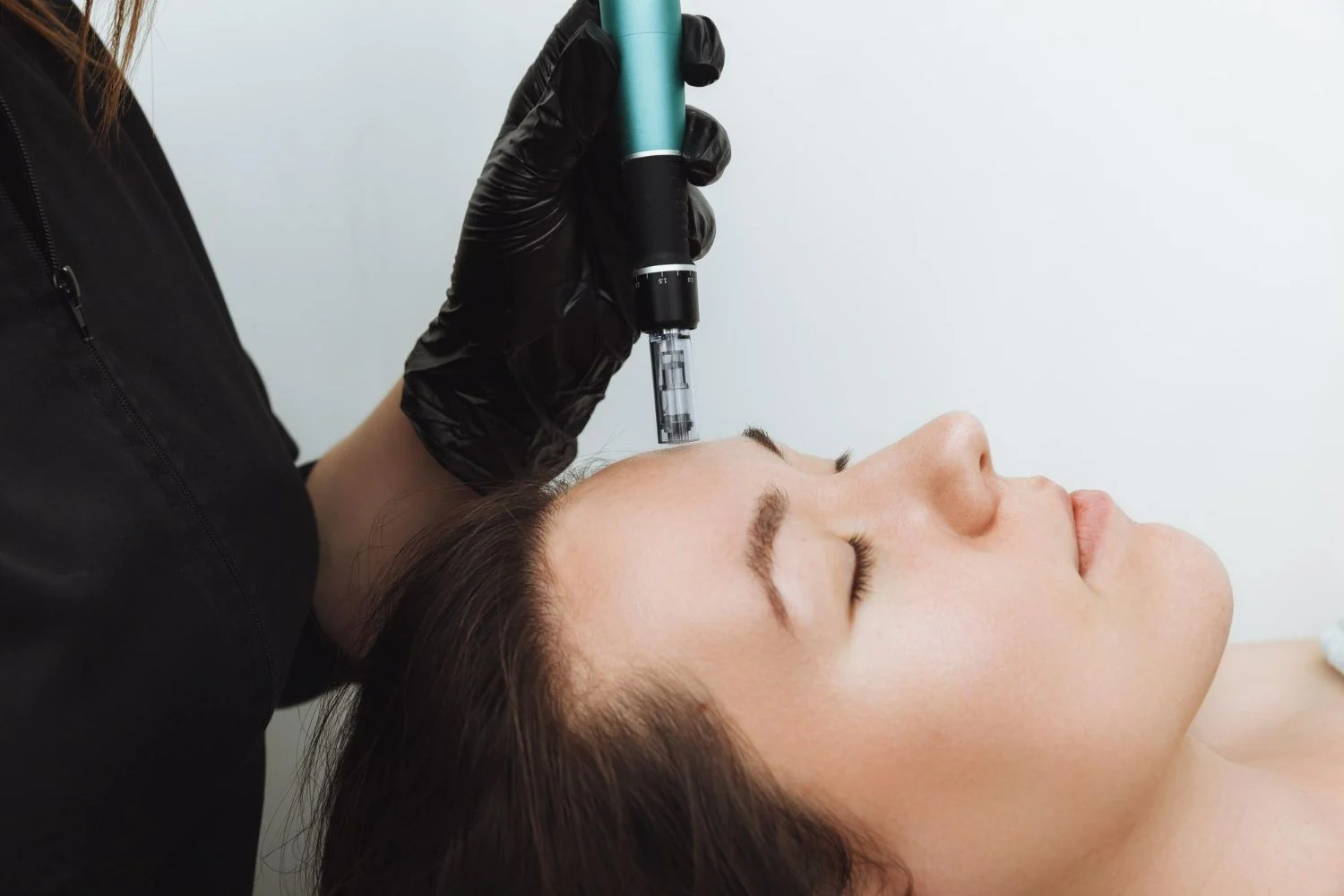 RF Microneedling Package