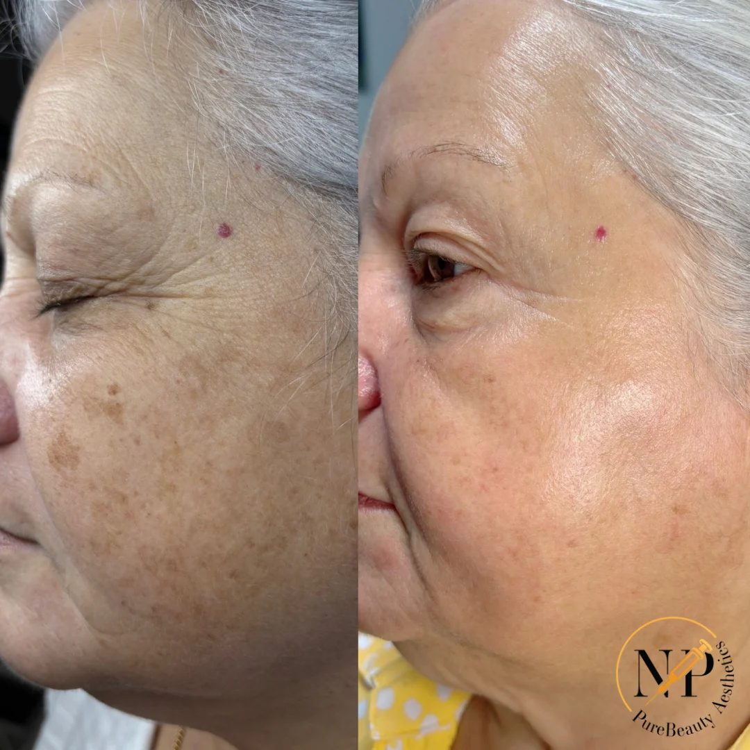 LaseMD Before & After